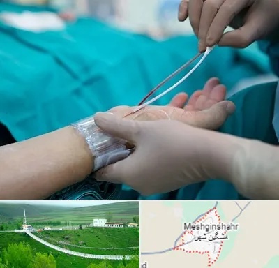 آنژیوگرافی در مشگین شهر
