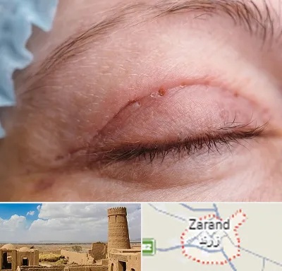 جراح پلک در زرند