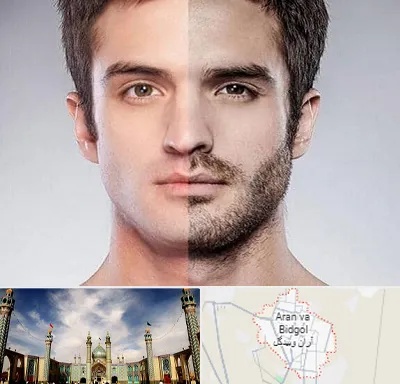 کاشت ریش و سبیل در آران و بیدگل