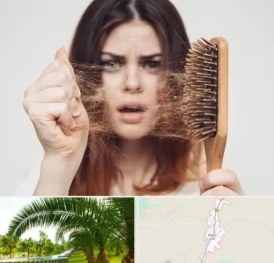 دکتر ریزش مو در کهنوج