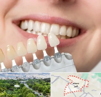 مرکز کامپوزیت دندان در البرز