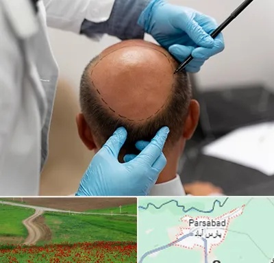 آموزش کاشت مو در پارس آباد