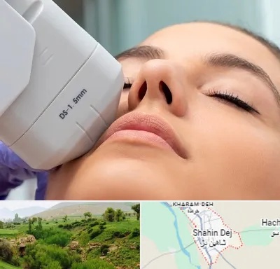 هایفوتراپی در شاهین دژ