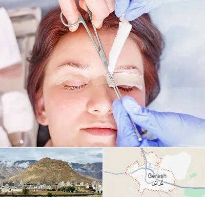 جراحی پلک افتاده در گراش