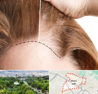 کاشت مو برای خانمها در البرز