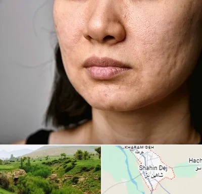 سابسیژن جای جوش در شاهین دژ