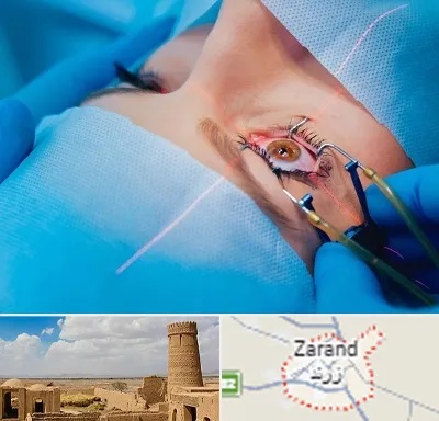 عمل prk چشم در زرند