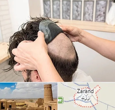 پروتز مو در زرند