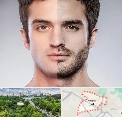 کاشت ریش و سبیل در البرز