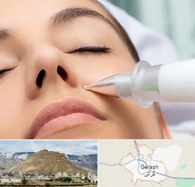 پلاسما جت بینی در گراش