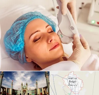 اکسنت در آران و بیدگل