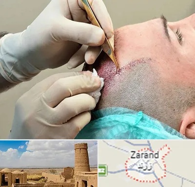 اسکالپ موی سر در زرند