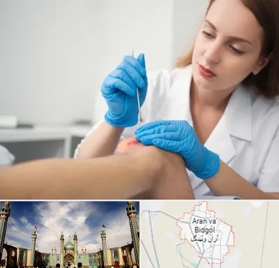 متخصص زخم در آران و بیدگل