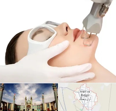 لیزر فرکشنال در آران و بیدگل