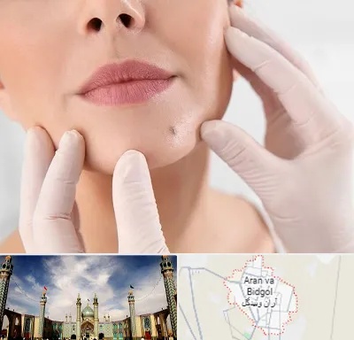 برداشتن خال در آران و بیدگل