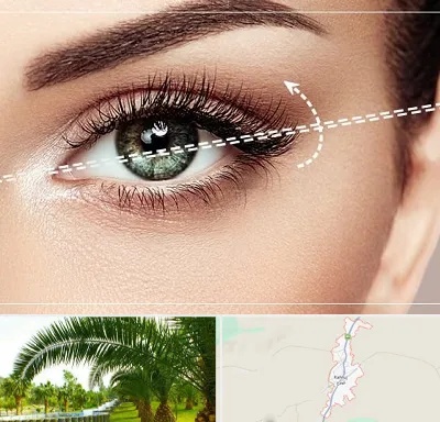 جراحی چشم گربه ای در کهنوج