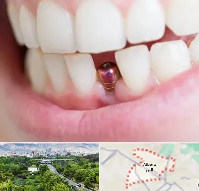 ایمپلنت اقساطی در البرز