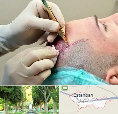 کلینیک کاشت مو در استهبان