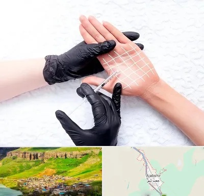 تزریق بوتاکس کف دست در عجب شیر