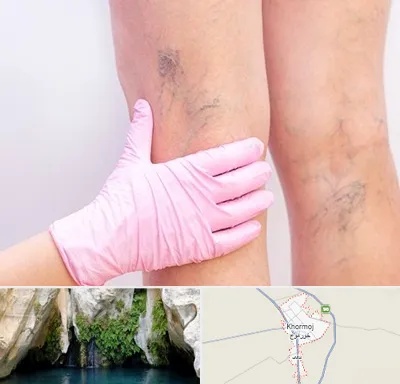 دکتر فوق تخصص واریس در خورموج