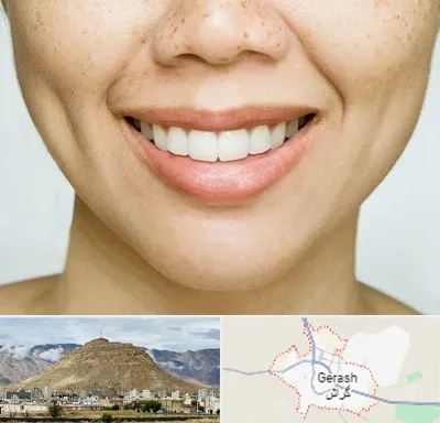 عمل چال گونه در گراش