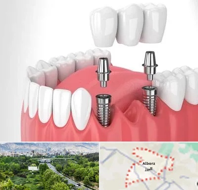 کاشت دندان در البرز
