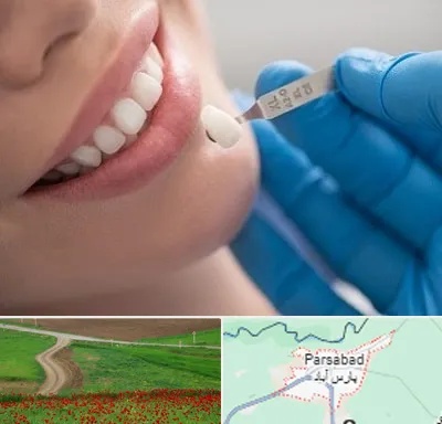 مرکز لمینت دندان در پارس آباد