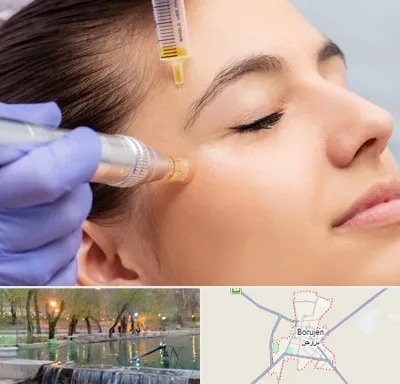 میکرونیدلینگ در بروجن
