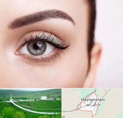 فوق تخصص عنبیه در مشگین شهر