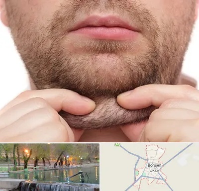 ساکشن غبغب در بروجن
