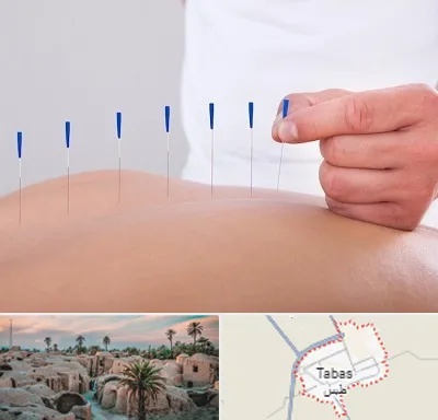 دکتر طب سوزنی در طبس