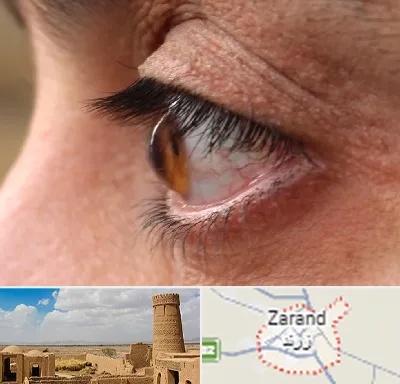 متخصص قوز قرنیه در زرند