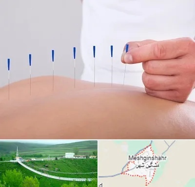 دکتر طب سوزنی در مشگین شهر