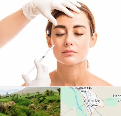 تزریق ژل گونه در شاهین دژ