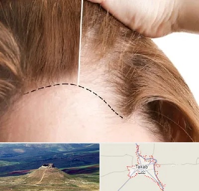 کاشت مو برای خانمها در تکاب