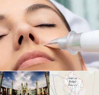 پلاسما جت بینی در آران و بیدگل