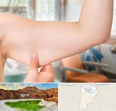 براکیوپلاستی در گرمسار