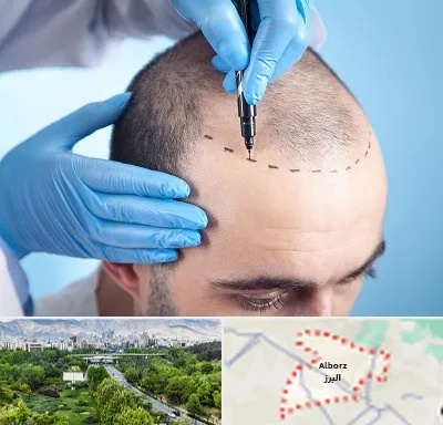 دکتر کاشت مو در البرز