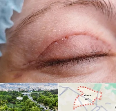 جراح پلک در البرز
