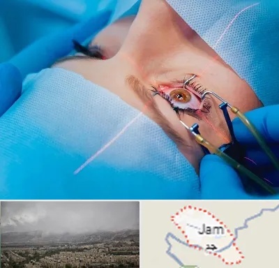 عمل prk چشم در جم