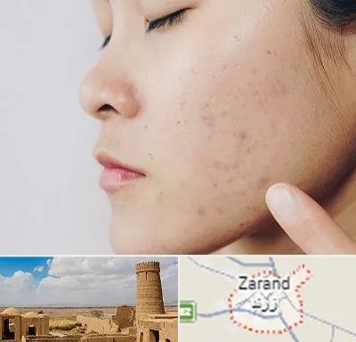 دکتر جوش صورت در زرند