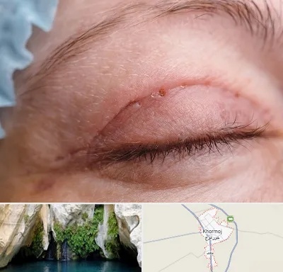 جراح پلک در خورموج
