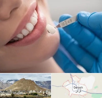 مرکز لمینت دندان در گراش
