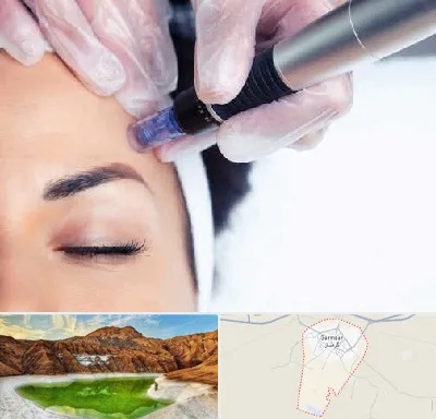 کلینیک مزوتراپی صورت در گرمسار