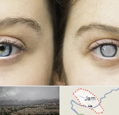 متخصص آب سیاه (گلوکوم) در جم