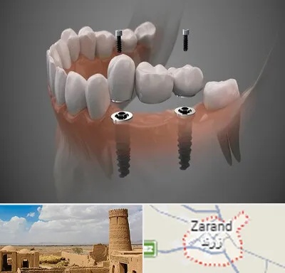 ایمپلنت دیجیتال در زرند