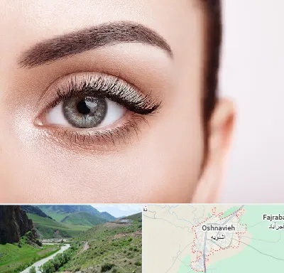 فوق تخصص عنبیه در اشنویه