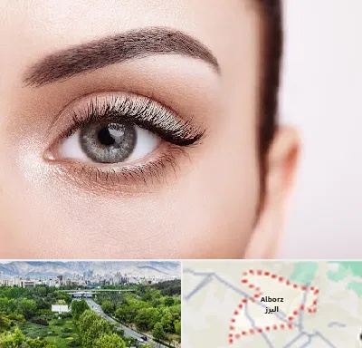فوق تخصص عنبیه در البرز