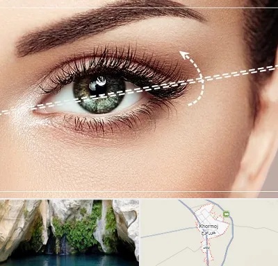 جراحی چشم گربه ای در خورموج