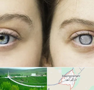 متخصص آب سیاه (گلوکوم) در مشگین شهر